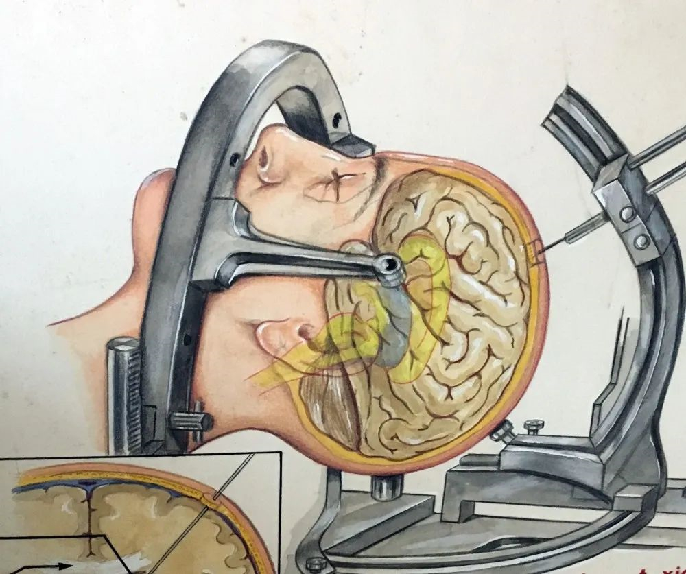 探索換腦術 美國政府或斥1.1億美元啟動腦組織替代計劃