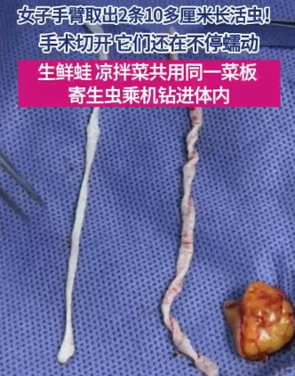 廣東一女子手臂切開鑽出活蟲 連醫生都被嚇到